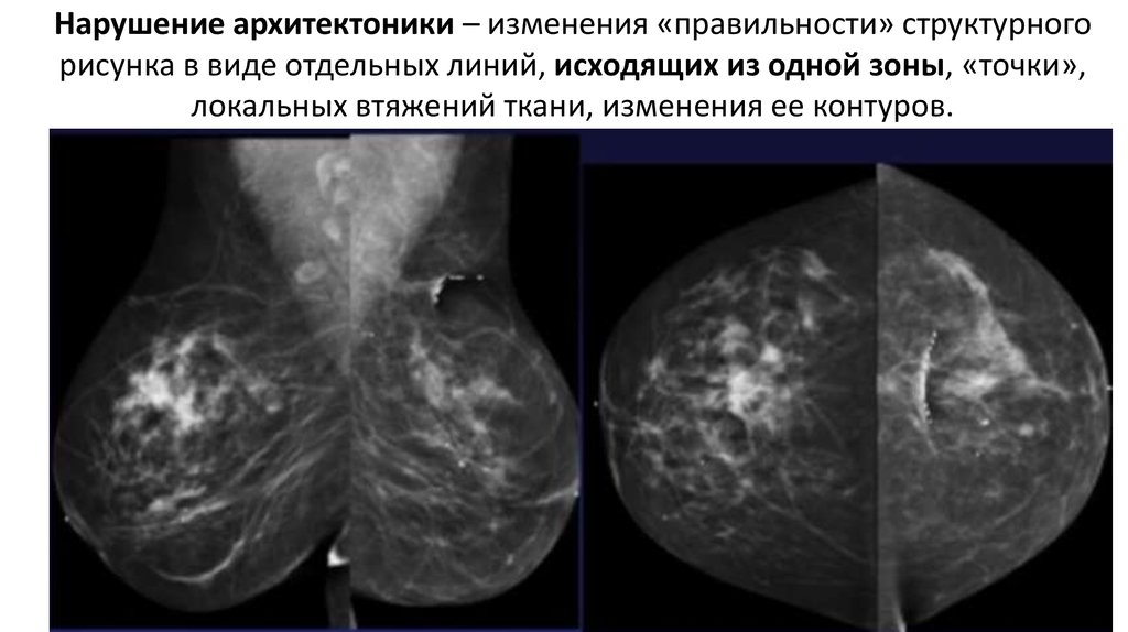 Проекции в маммографии