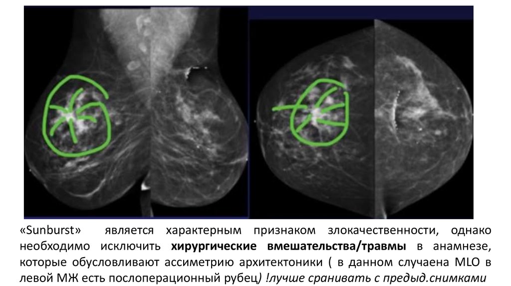 Что значит маммография. АСК маммография. Послеоперационный рубец на маммографии фото и описание. Показывает ли рубец после операции на маммографии фото и описание.