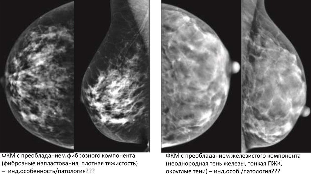 Маммография ростов на дону. Кистозная мастопатия маммография. Фиброзно кистозная мастопатия маммограмма. Фиброкистоз маммография. Фиброзно-кистозная мастопатия фотоснимки.
