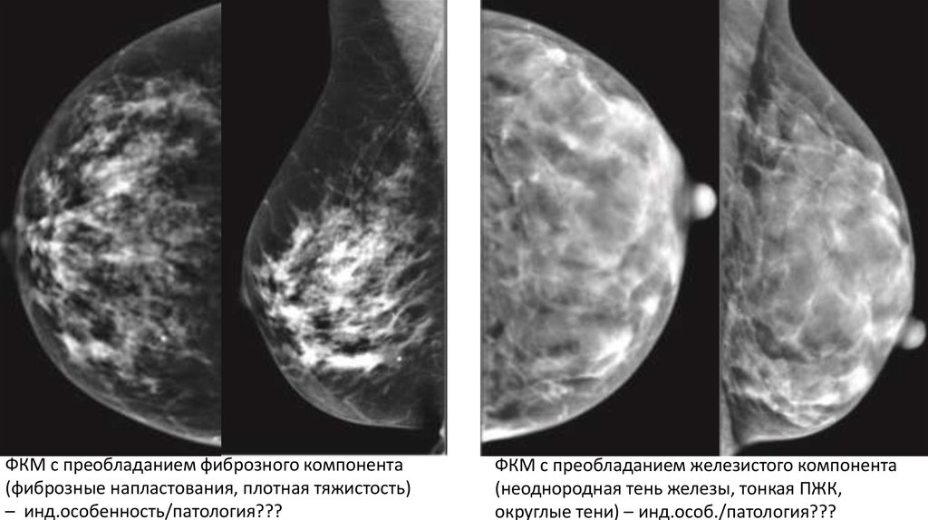 Маммография на какой. Фиброзно кистозная мастопатия маммограмма. Фиброкистозная мастопатия. Фиброзно-кистозная мастопатия молочных желез мрт. Маммография фиброзно кистозная мастопатия снимки.
