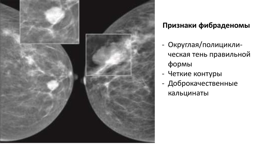 Округлые кальцинаты. Маммография микрокальцинаты. Фиброз молочной железы на маммографии. Маммография раковые микрокальцинаты. Кальцинаты молочной железы.