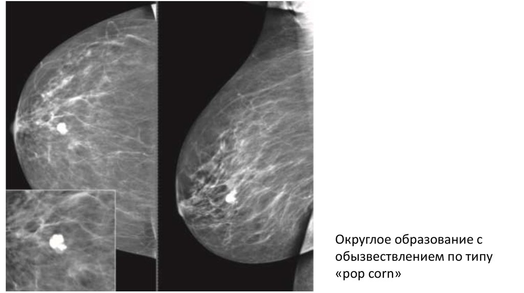 Округлые образования в молочной железе. Маммография микрокальцинаты. Маммография интрамаммарный узел. ЗНО молочной железы на маммографии.