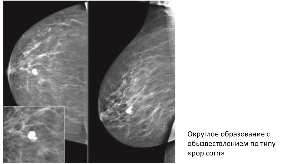 Образование молочной. Образования маммография. Типы плотности молочных желез маммография. Маммография презентация.