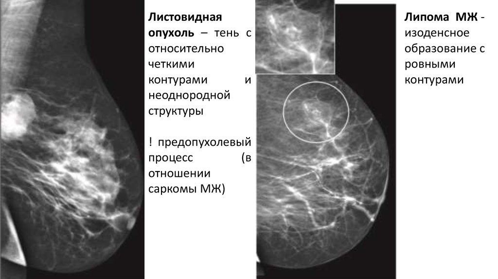 Молочная железа листовидная опухоль. Новообразование с четкими контурами. Липома неоднородной структуры.