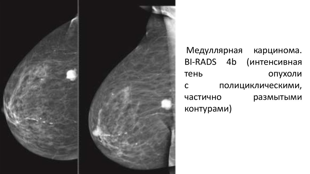 Маммография молочных желез 4. Маммография молочных bi-rads 2. Фиброзно кистозная мастопатия молочной железы bi-rads-4a. Маммография шкала bi-rads. Категория bi rads маммография.
