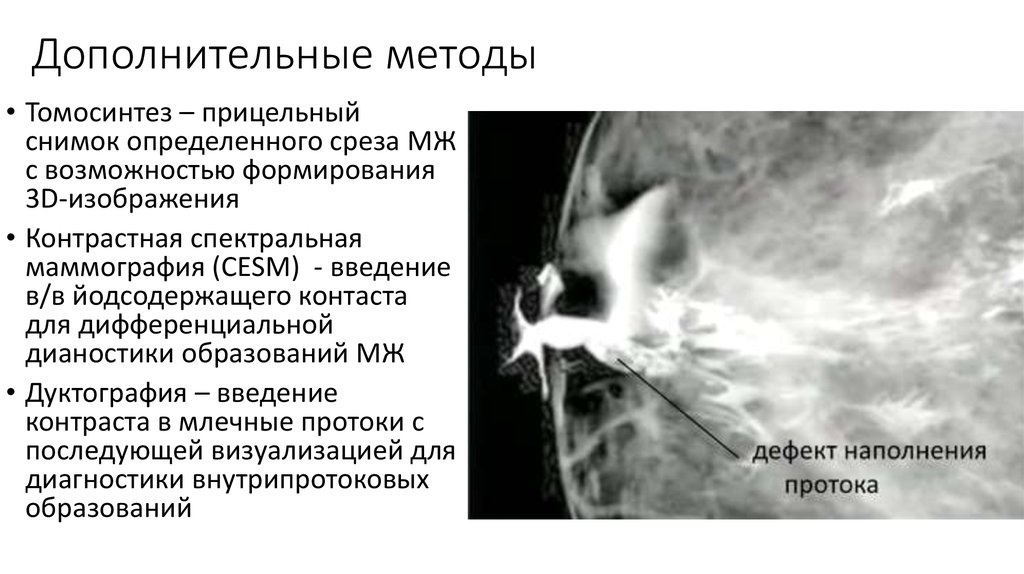 Маммография виды. Контрастная спектральная маммография. Прицельный снимок маммографии. Маммография молочных желез. Онкология на маммографии.