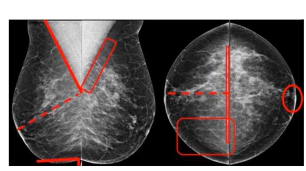 Маммография ростов на дону. Маммография. Маммография молочных желез. Маммография снимок в норме. Маммография презентация.