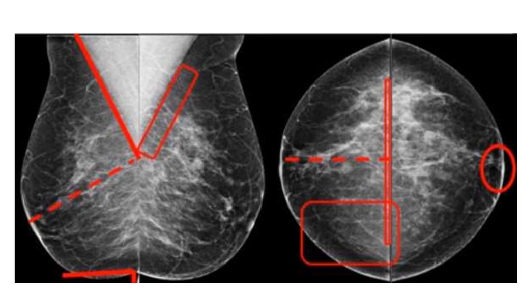 Как расшифровать маммографию. Маммография №. Почему результат маммографии не ждать 10 дней.