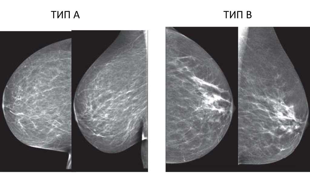 Маммография фкм. Маммография Тип с по ACR. Фиброзно-кистозная мастопатия маммография. Отделы молочной железы маммография. Маммография здоровых молочных желез.