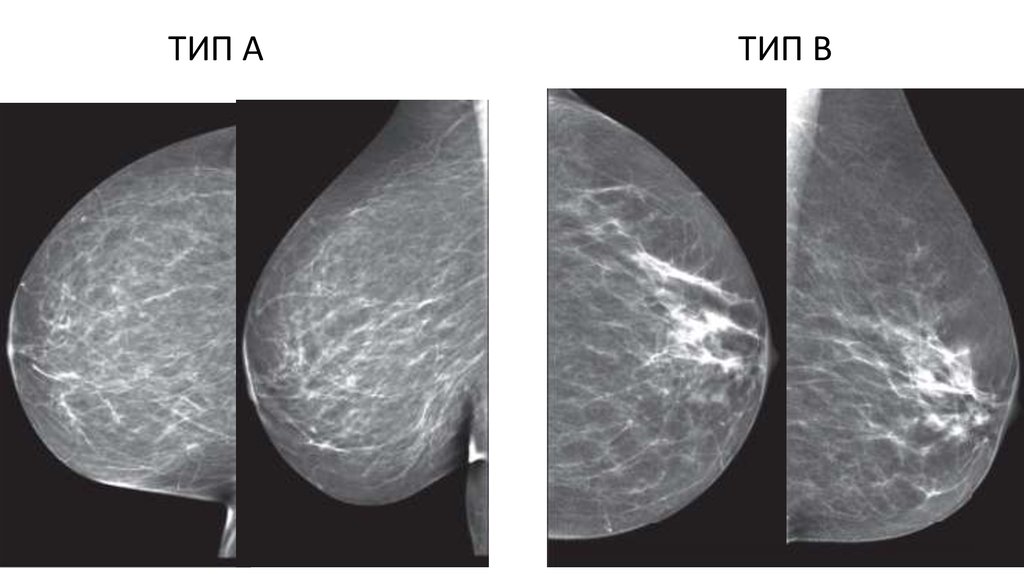 Тип молочной железы. Маммография Тип с по ACR. Маммография здоровых молочных желез. Маммография здоровой груди. Маммография двух молочных желез в двух проекциях.