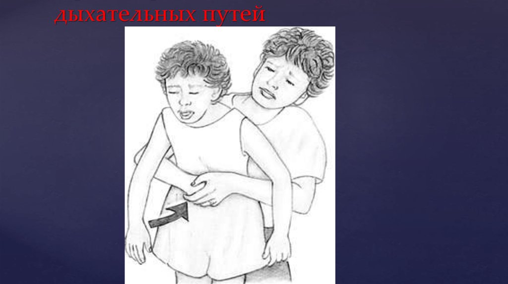 При инородном теле дыхательных путей