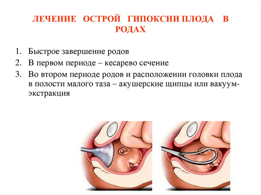 Лечение гипоксии у новорожденных