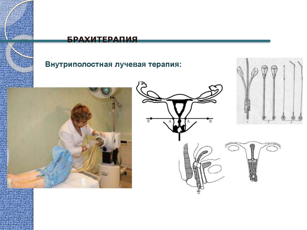 Лучевая терапия матки. Аппарат внутриполостной лучевой терапии. Внутриполостная лучевая терапия. Внутриполостной метод лучевой терапии. Внутриполостная аппликационная лучевая терапия.