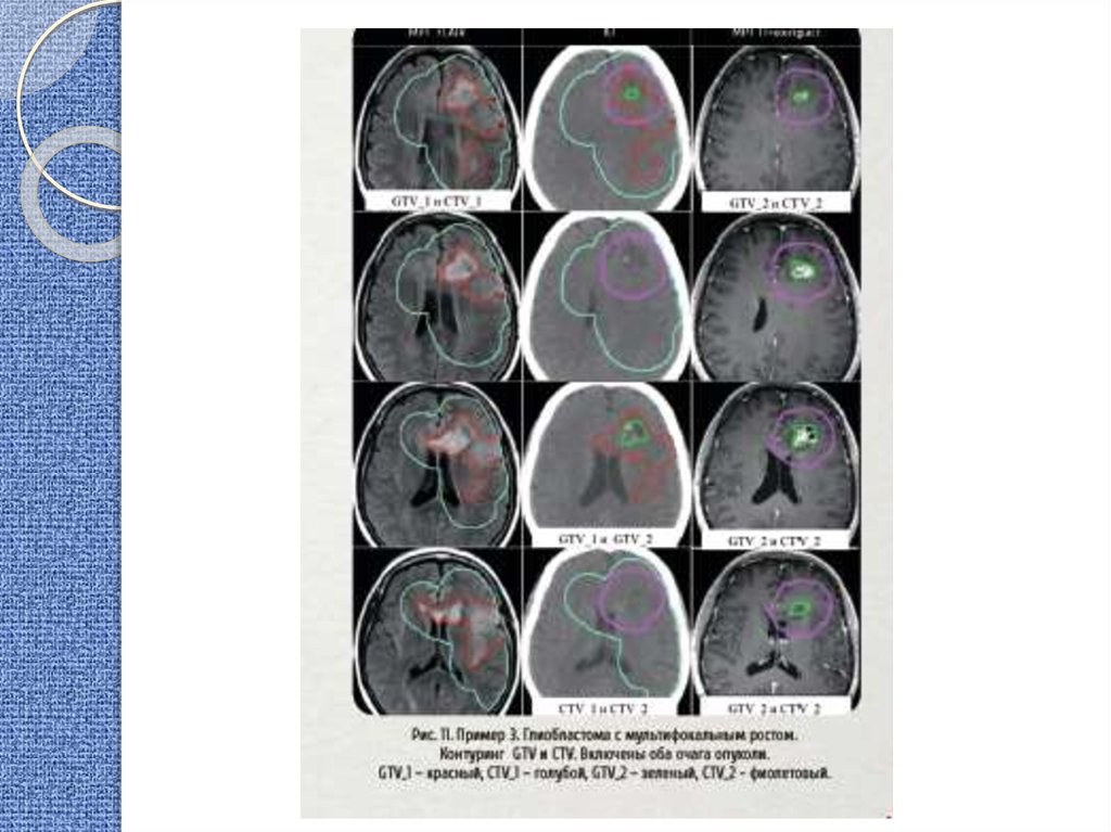 Онкорадиология лучевая диагностика и терапия. Облучение при онкологии головного мозга +последствия +шансы. GTV CTV PTV лучевая терапия.