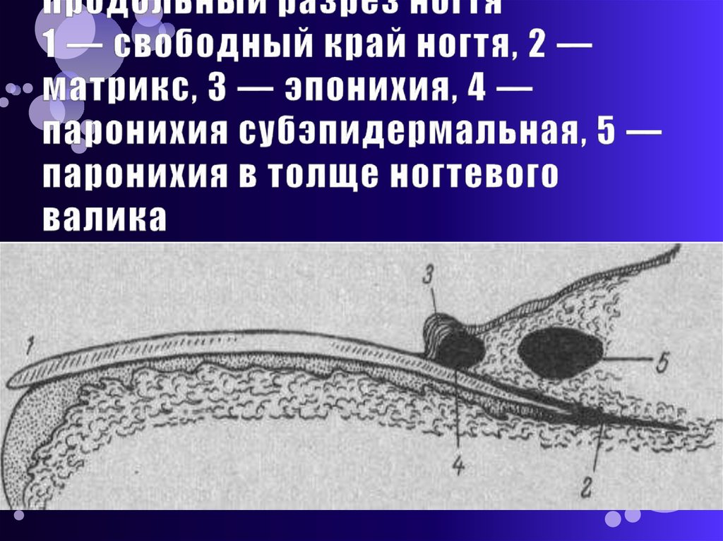 Продольный разрез ногтя 1 — свободный край ногтя, 2 — матрикс, 3 — эпонихия, 4 — паронихия субэпидермальная, 5 — паронихия в