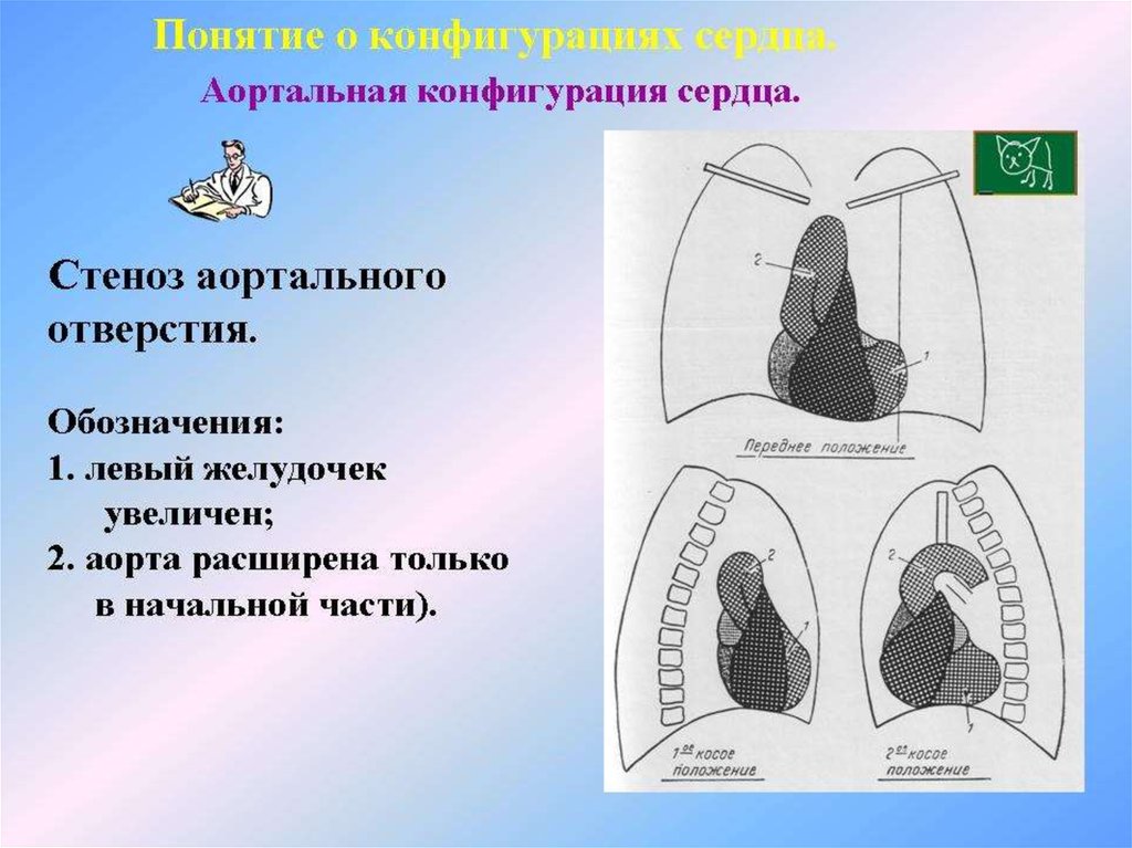 Конфигурация сердца аортальная схема