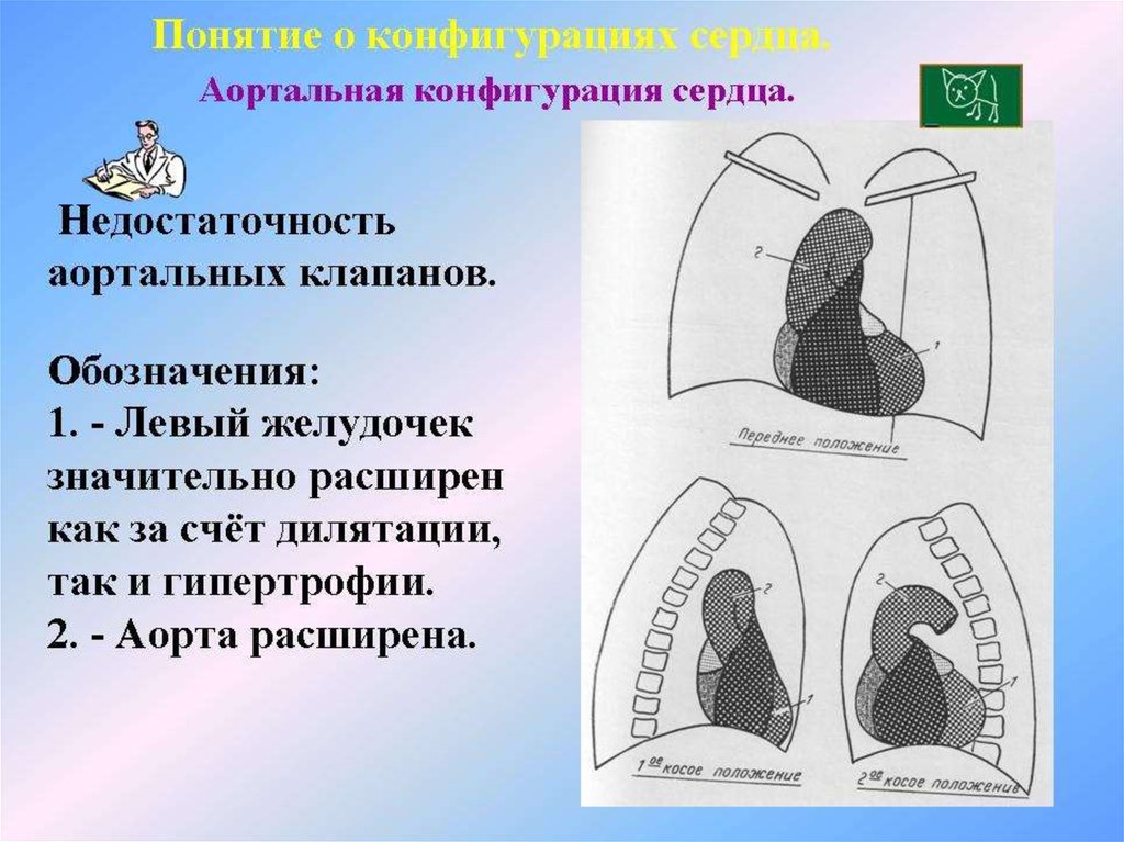 Конфигурация сердца аортальная схема