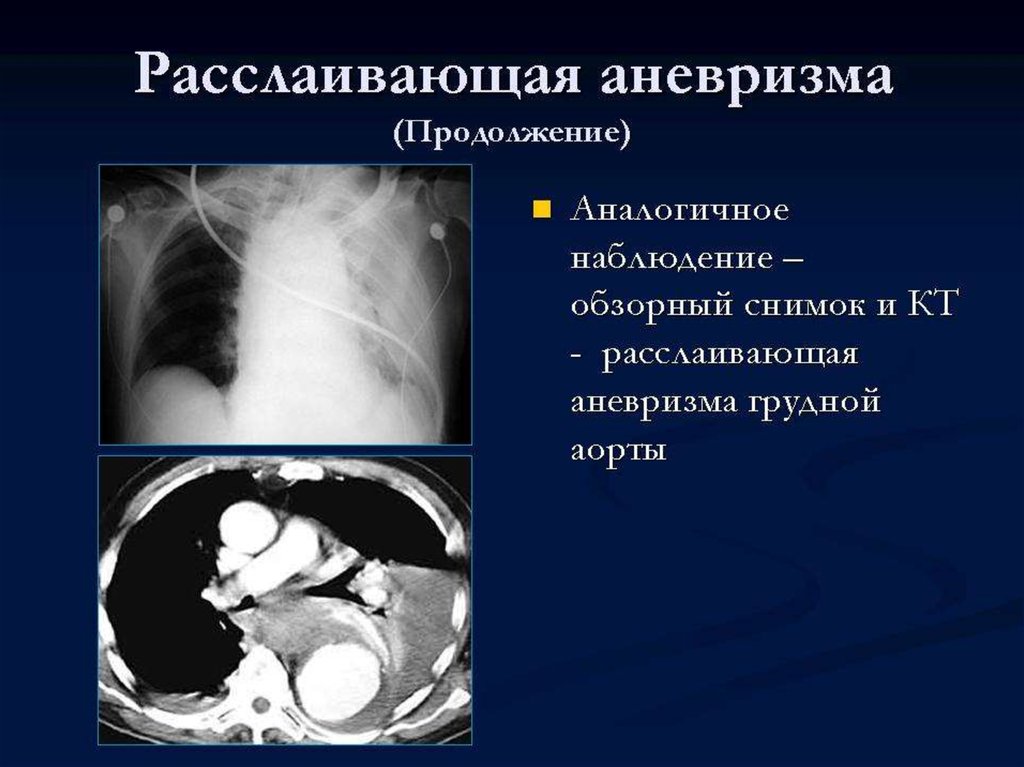 Расслаивающаяся аорта. Расслаивающаяся аневризма грудной аорты кт. Расслаивающая аневризма брюшной аорты кт. Расслаивающая аневризма брюшного отдела аорты. Аневризма грудного отдела аорты рентген.