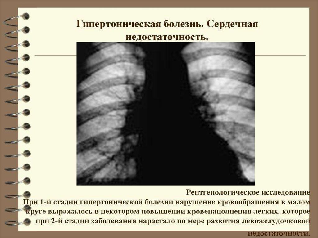 Сердечная недостаточность обследование. Рентгенография органов грудной клетки при ХСН. Рентгенография грудной клетки при гипертонической болезни. Рентгенография грудной клетки при легочной гипертензии. Рентгенография органов грудной клетки при гипертонической болезни.