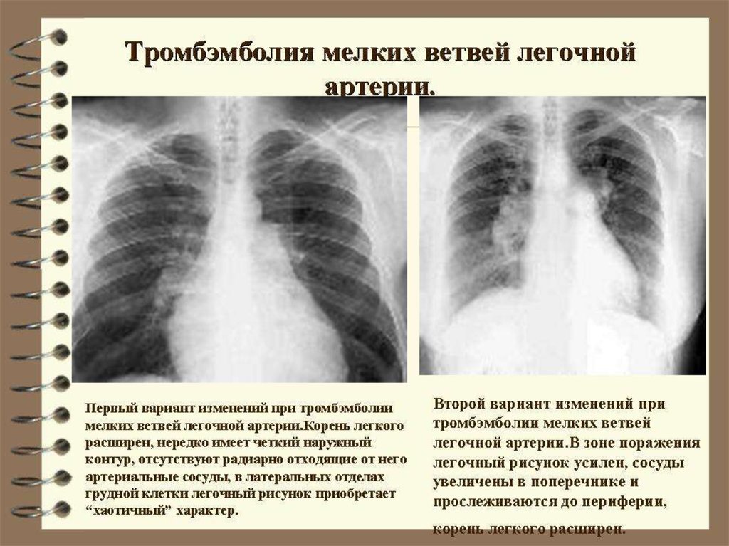 Патология легочного рисунка на рентгенограмме
