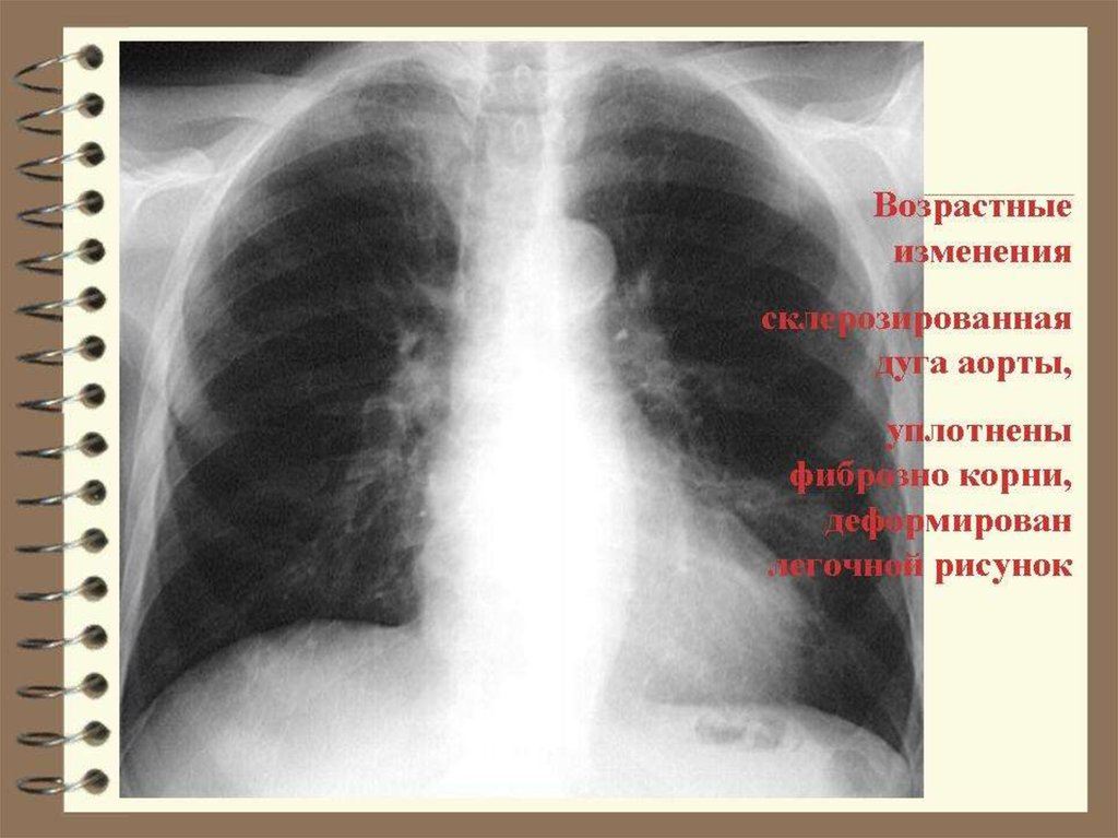 Возрастные изменения в легких. Рентген уплотнение корня лёгкого. Флюорография. Аорта уплотнена на флюорографии.