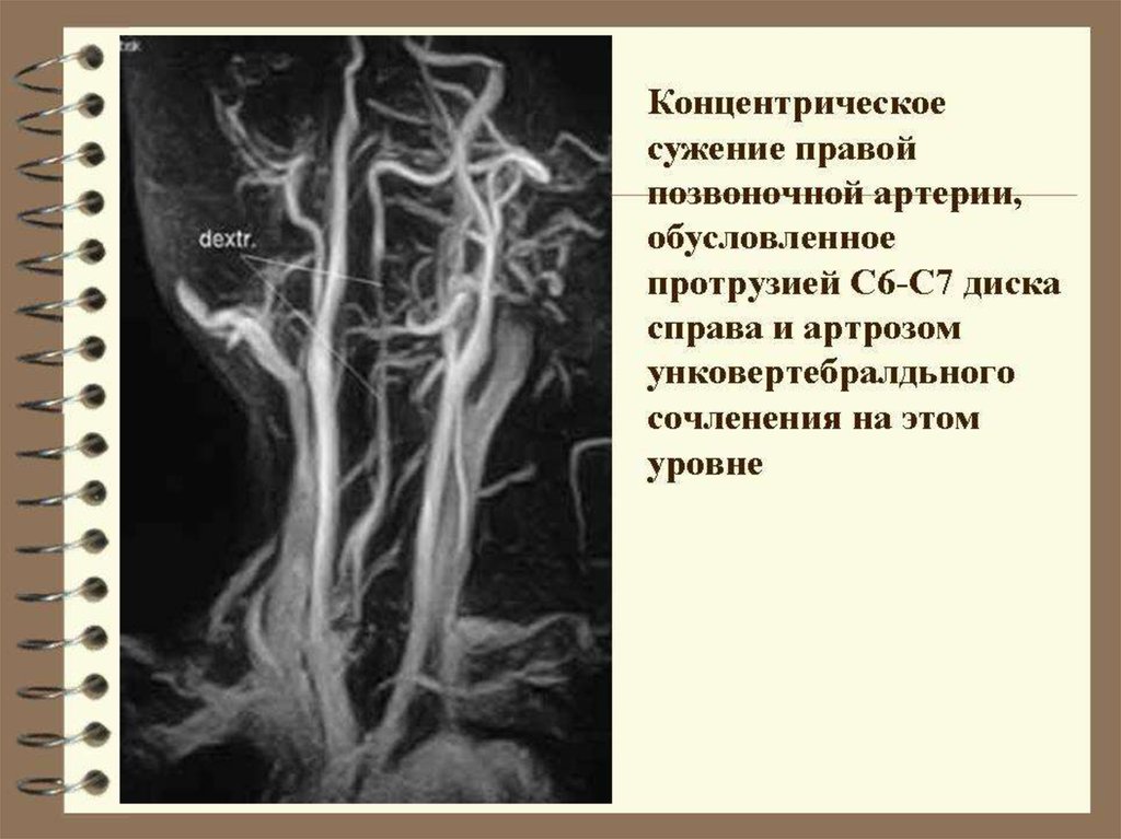 Правая позвоночная. Сужение позвоночной артерии. Стеноз правой позвоночной артерии. Сужение правой позвоночной артерии. Сужение дистальных отделов обеих позвоночных артерий.