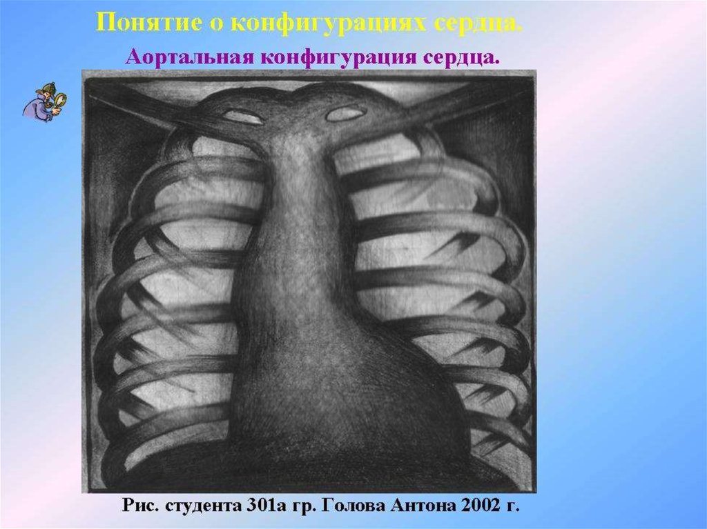 Аортальная конфигурация сердца. Аортальная конфигурация патология. Аортальная конфигурация сердца патологии. Конфигурация сердца в рентгенологии. Рентгенологическая диагностика сердечно сосудистой системы.