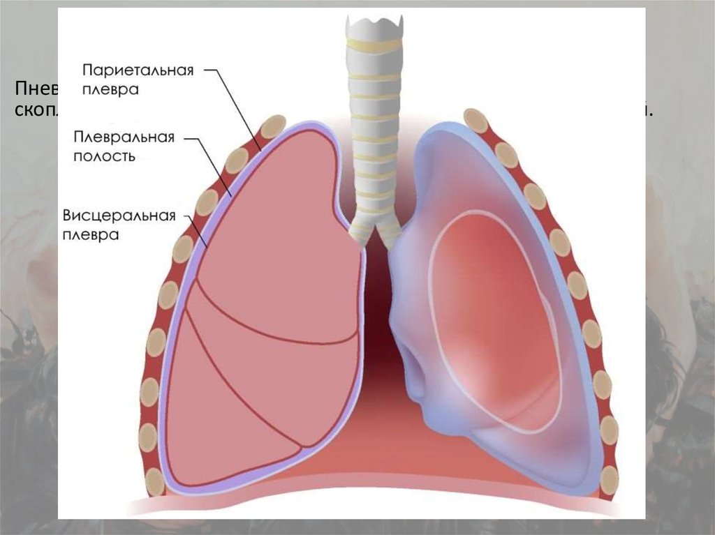 Плеврит легких что это. Пневмоторакс плевральная жидкость. Висцеральная и париетальная плевра плевральная полость. Висцеральная плевра легких. Висцеральная (легочная) плевра.