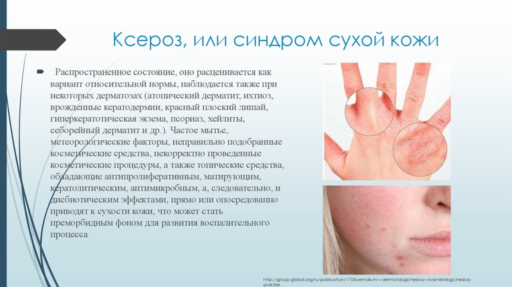 Ксероз, или синдром сухой кожи