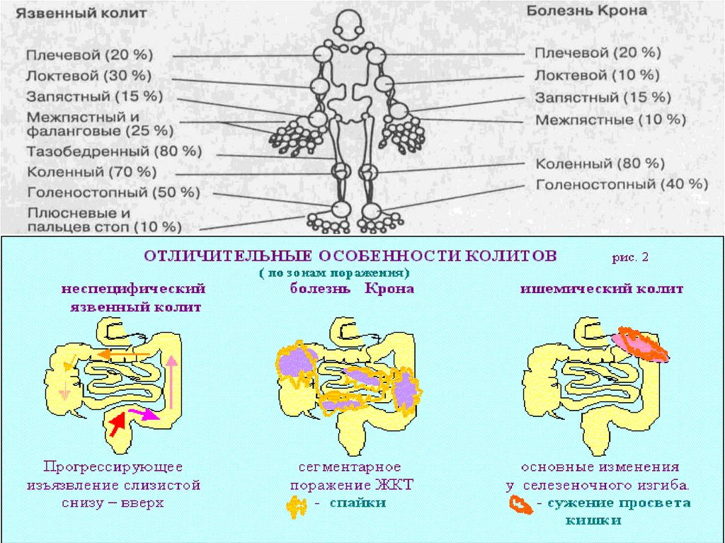 Схема лечения колита