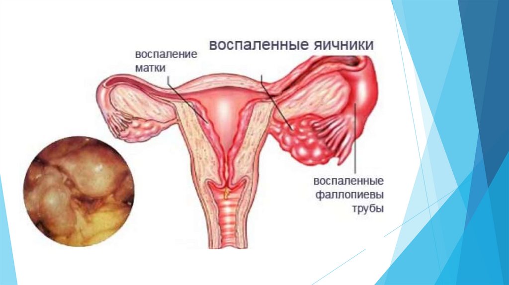 Воспаление внутренней оболочки матки. Сальпингоофорит (аднексит). Сальпингоофорит яичника.