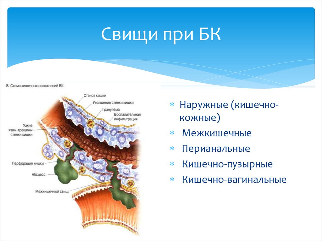 Свищ это простыми словами