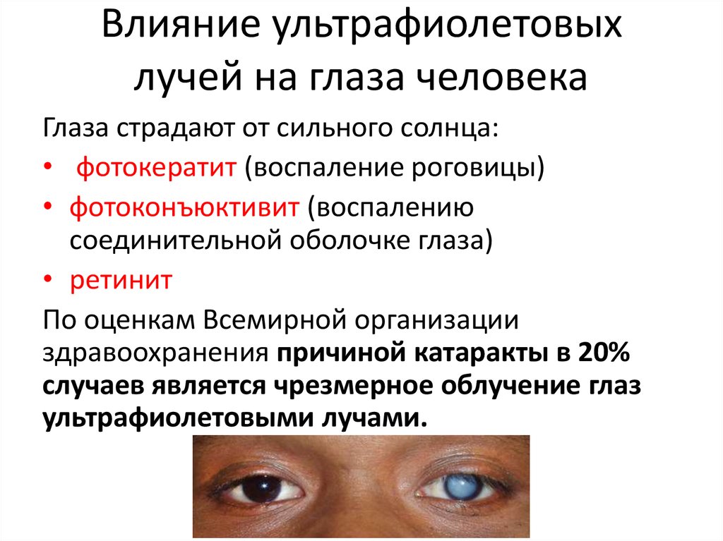 Влияние ультрафиолетовых лучей на глаза человека