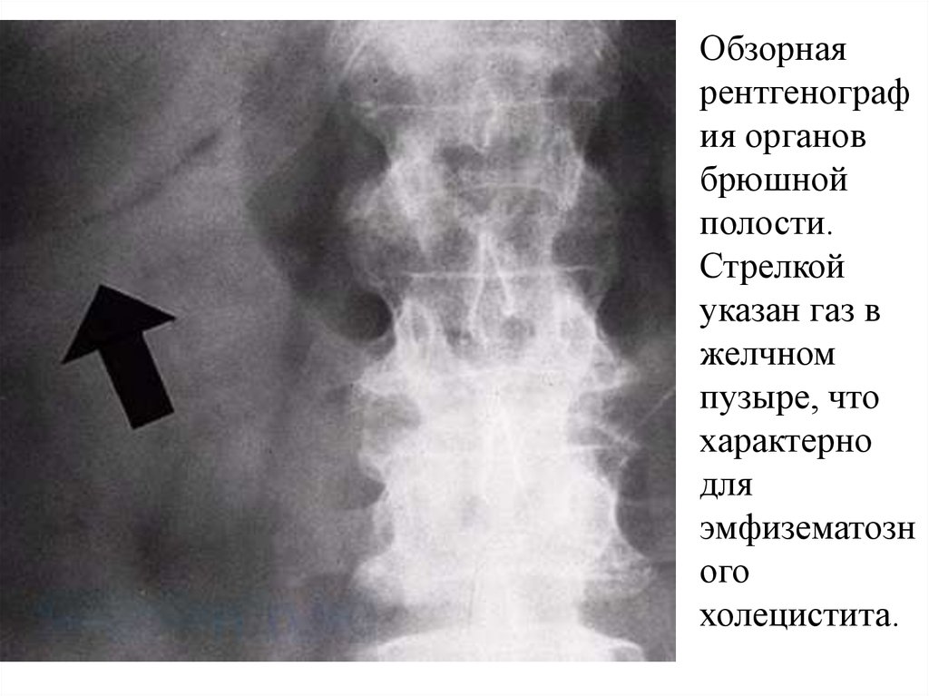 Обп что это. Обзорная рентгенография острый холецистит. Обзорная рентгенография при ЖКБ. Рентген брюшной полости при ЖКБ. Обзорная рентгенография желчного пузыря.