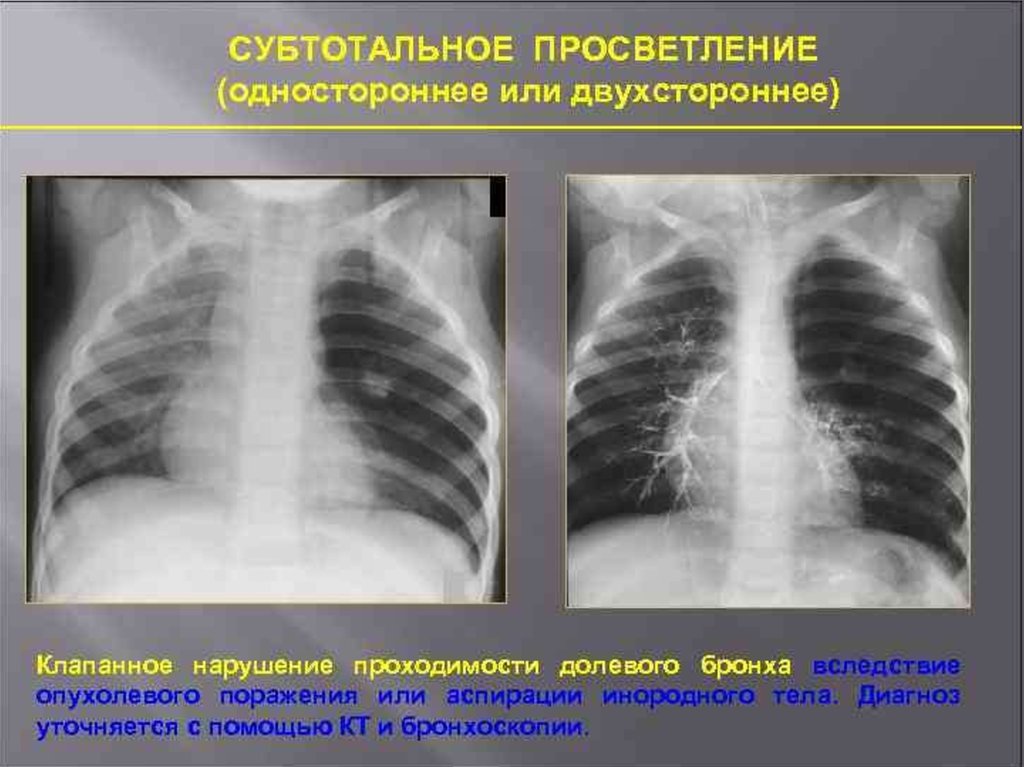 Поля легких. Обширное просветление легочного поля рентген. Субтотальное затемнение легких рентген. Субтотальная пневмония. Синдром просветления легочного поля.