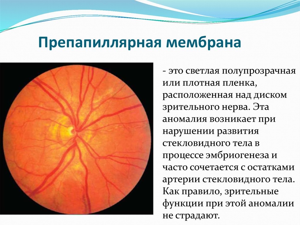 Периневральное пространство зрительного нерва. Миелиновые волокна ДЗН. Глазное дно миелиновые волокна. Перипапиллярная зона сетчатки. Аномалии ДЗН препапиллярная мембрана.