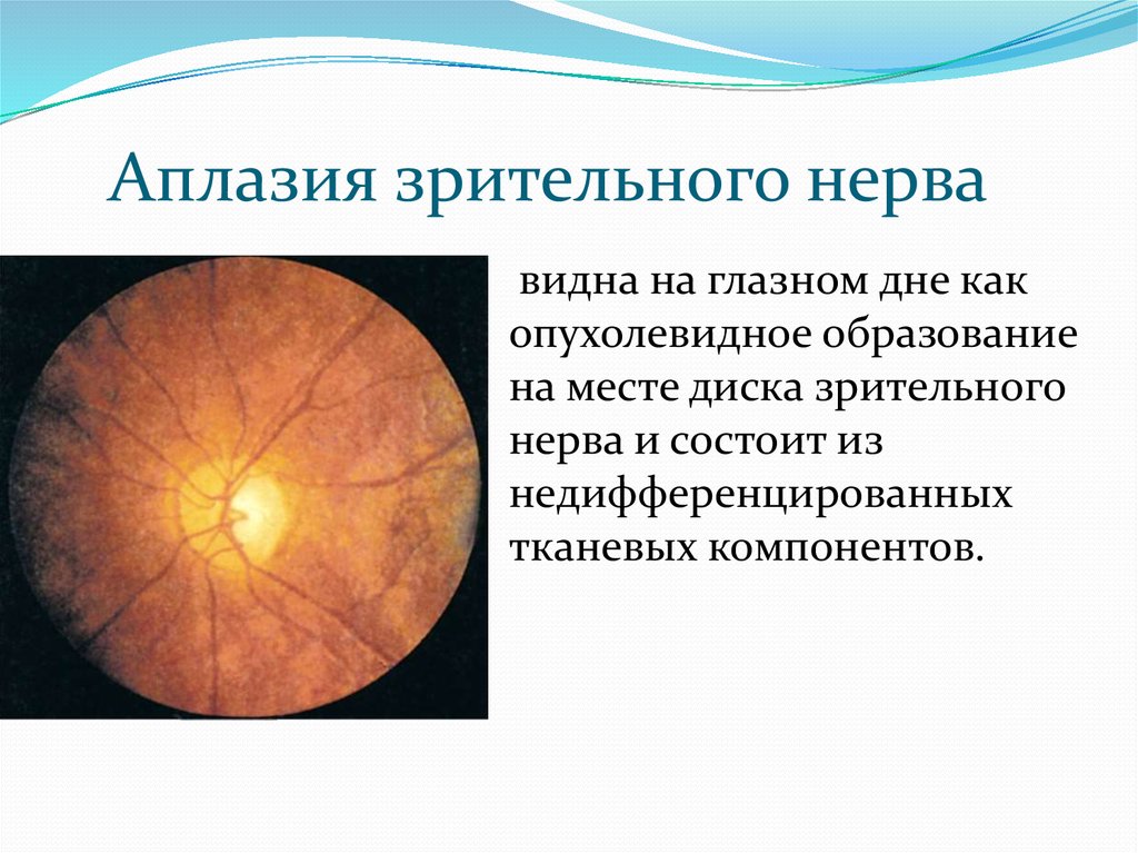Аномалия развития зрительного нерва. Колобома зрительного нерва. Врожденная колобома диска зрительного нерва. Аплазия диска зрительного нерва. Врожденные аномалии ДЗН.