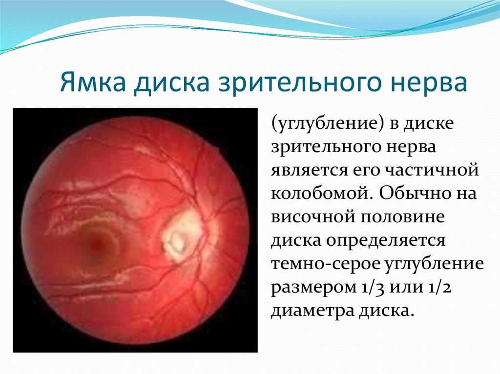 Аномалия развития зрительного нерва. Ямка диска зрительного нерва. Аномалии диска зрительного нерва. Углубление диска зрительного нерва. Ямочки зрительного нерва.