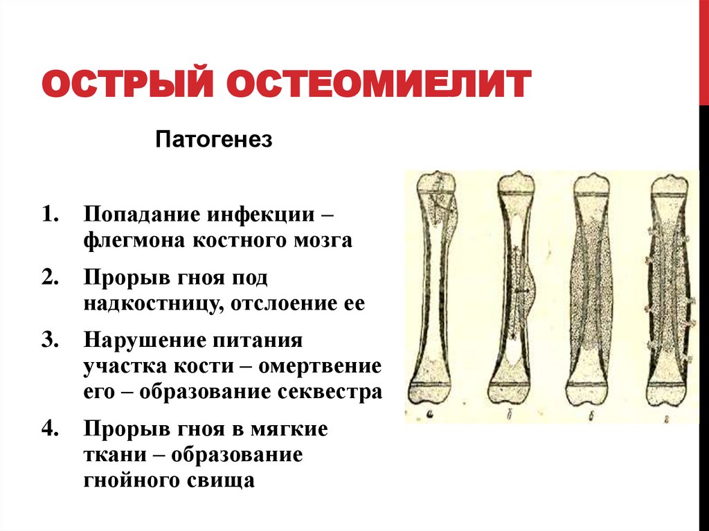 Стерильная кость