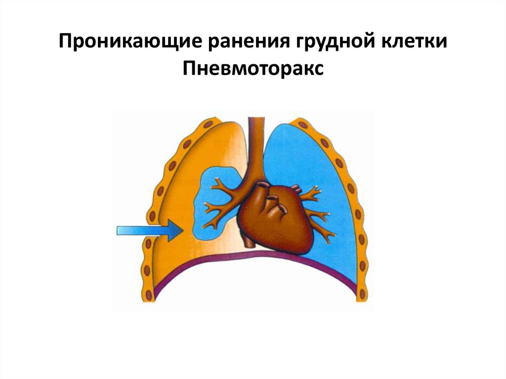 Проникающее ранение грудной