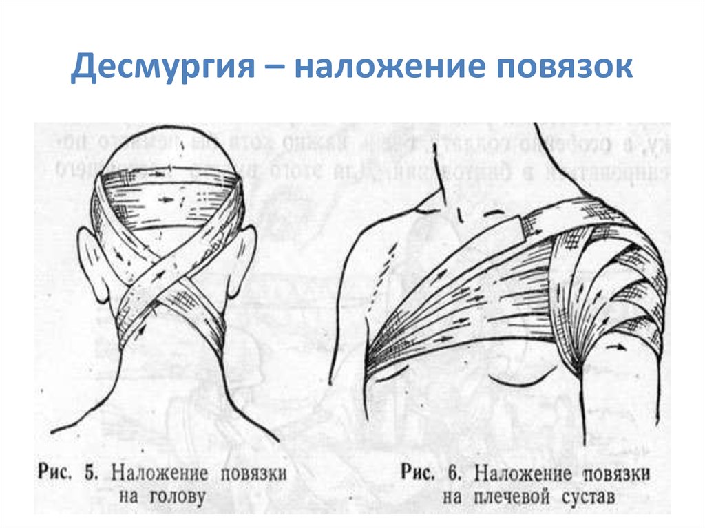 Наложение повязки на плечо