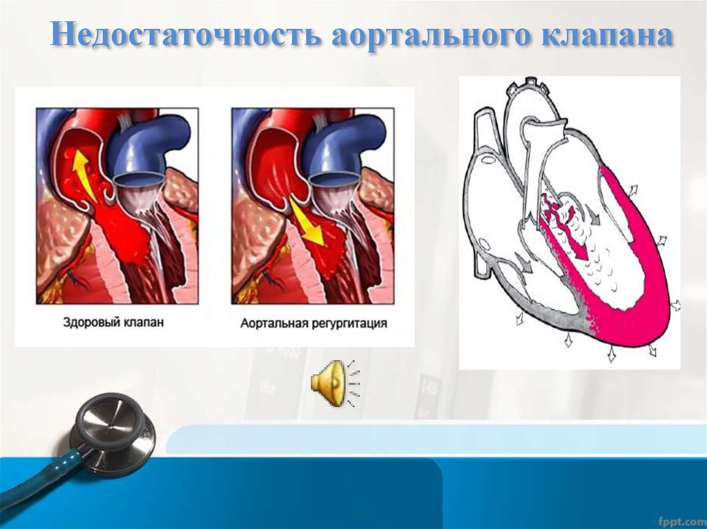 Амплитуда раскрытия аортального клапана