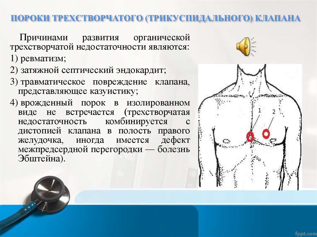 Аускультативная картина при трикуспидальной недостаточности