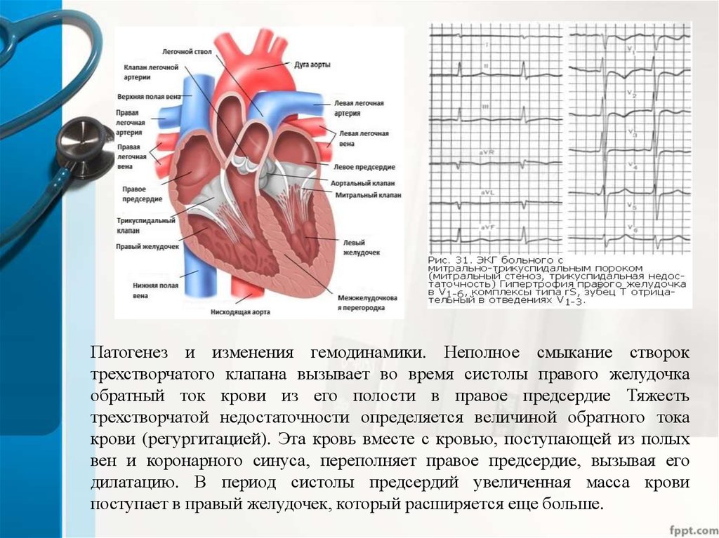 Недостаточность правого предсердия. Недостаточность трехстворчатого клапана гемодинамика. Гемодинамика трикуспидального клапана. Клапаны правого предсердия. Недостаточность трехстворчатого клапана патогенез.