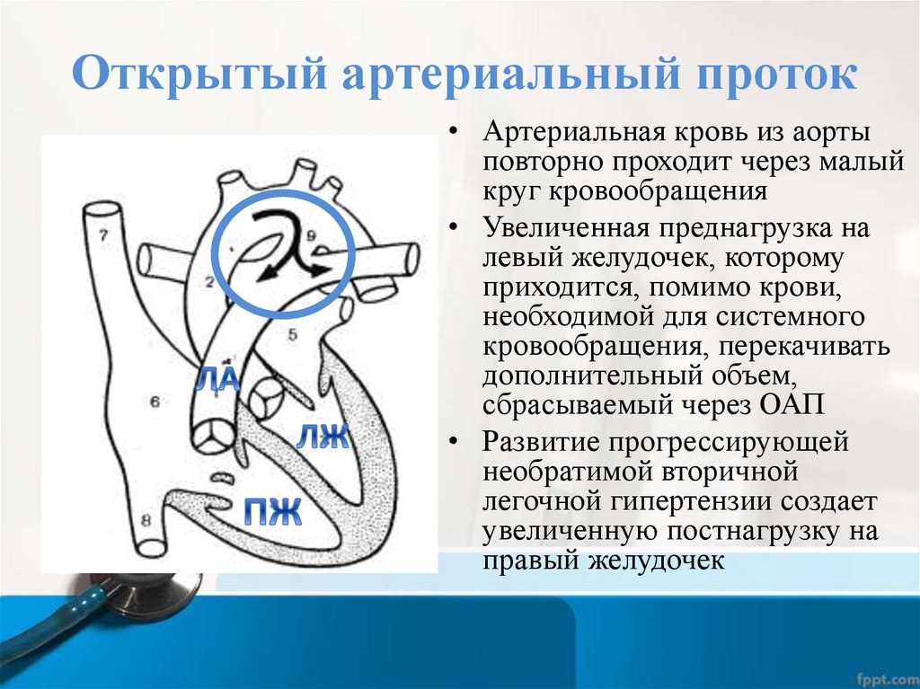 Функционирующий артериальный проток. ОАП гемодинамика схема. Открытый артериальный проток нарушение гемодинамики. ВПС Баталов проток. Гемодинамика открытого артериального протока.