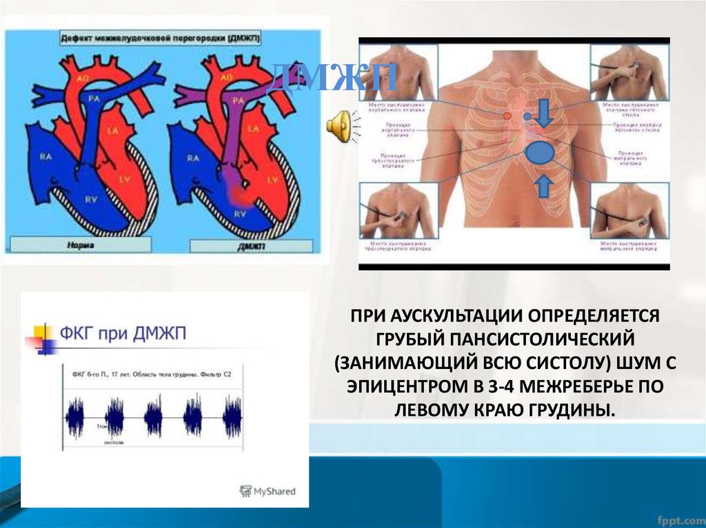 Дмпп аускультативная картина