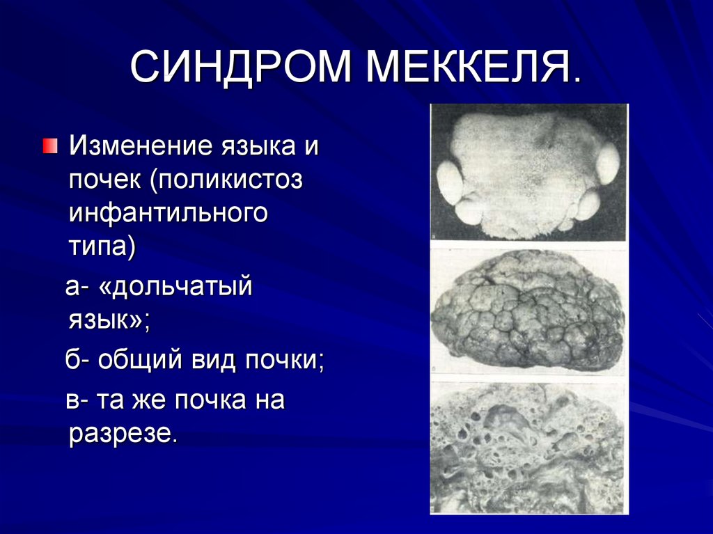 Синдром апера презентация