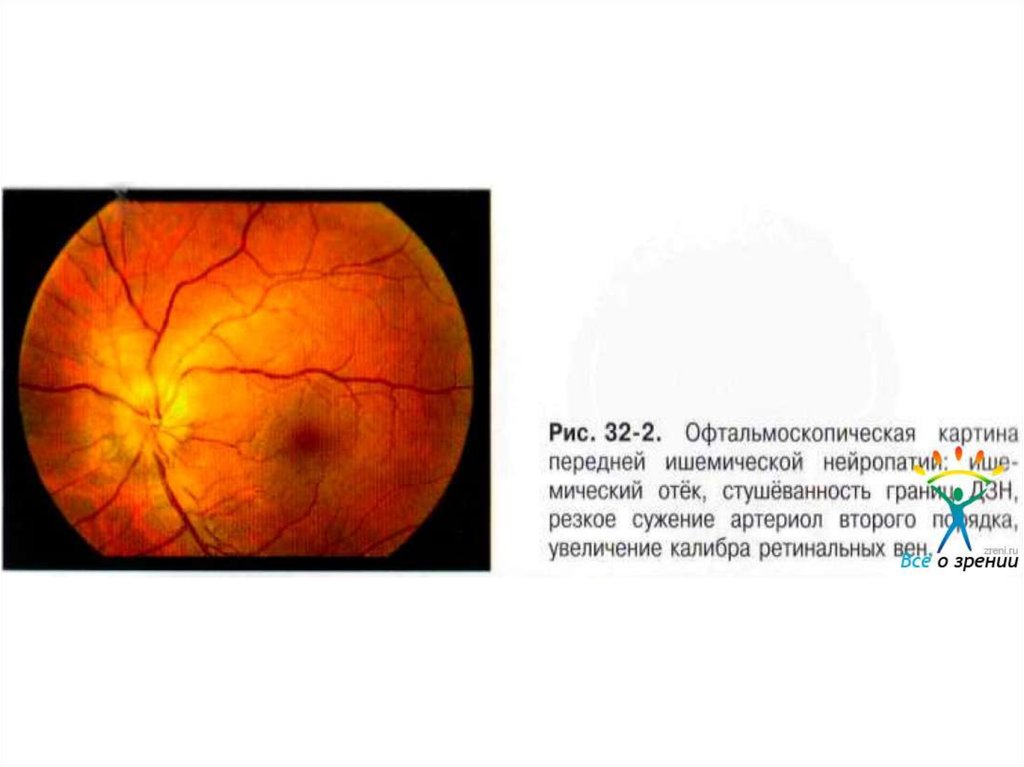 Передняя ишемическая нейропатия. Передняя ишемическая нейропатия зрительного нерва. Задняя ишемическая оптическая нейропатия. Ишемическая нейрооптикопатия глаза клинические рекомендации. Нейрооптикопатия зрительного нерва.