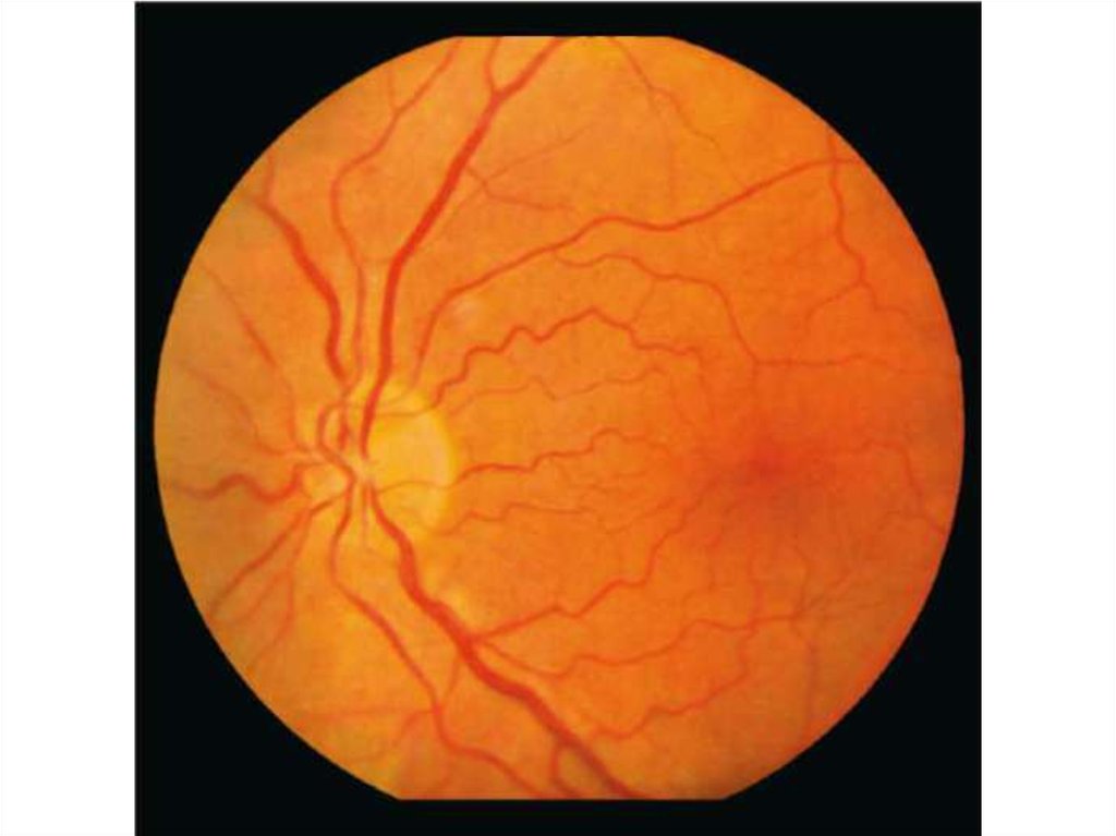 Нейропатия глаза. Ишемическая оптическая нейропатия. Ишемическая нейропатия сетчатки. Ишемическая нейропатия зрительного нерва. Ишемическая нейропатия глаза.