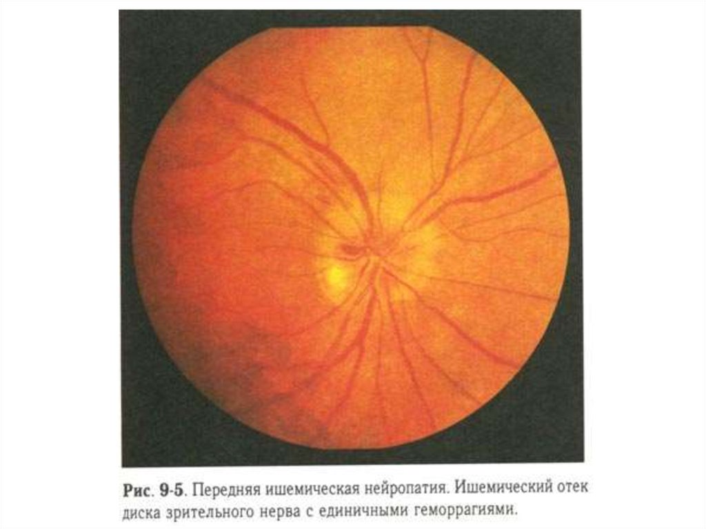 Нейропатия глаза. Нейрооптикопатия зрительного нерва. Ишемическая нейропатия глазное дно. Ишемическая нейропатия зрительного нерва. Ишемическая нейрооптикопатия зрительного нерва.